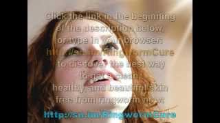 Ringworm Removal  Remove Ringworm in Humans [upl. by Enamart283]