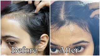 Best Hair Serums For Reduced Hair fall and Hair Growth [upl. by Grega]