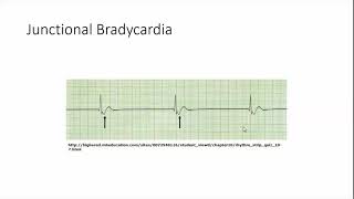 Junctional bradycardia [upl. by Lynea]