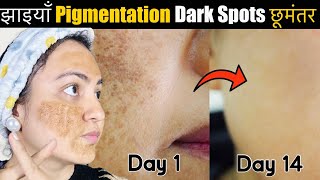 In 14 Days 💕Remove झाइयाँ Blemishes Pigmentation Dark Spots Naturally amp Get Clear Glowing Skin [upl. by Gnoh]