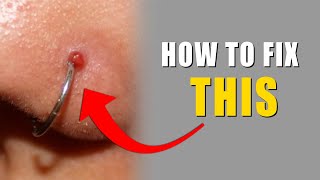 How I Removed My Nose Piercing Bump keloid  SAMADHAN [upl. by Hebner]