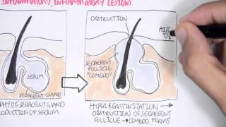 Acne Pathophsyiology [upl. by Edrea973]