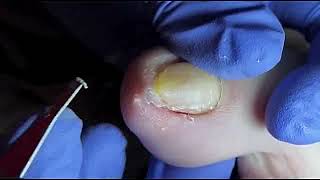 DIY Ingrown Toenail Removal  How to Safely Cut Ingrown Toenails at Home [upl. by Vonnie]