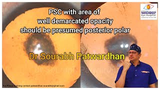 Posterior subcapsular or presumed posterior polar cataract  Thinking process Dr Sourabh Patwardhan [upl. by Ainimreh]