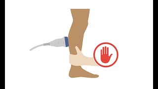 Venous ultrasound class Interpreting DVT compressibility and chronicity on ultrasound [upl. by Kohn]