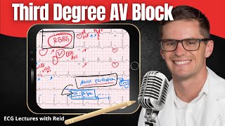 Third Degree Complete AV Block EKG  ECG Lecture [upl. by Henryk694]