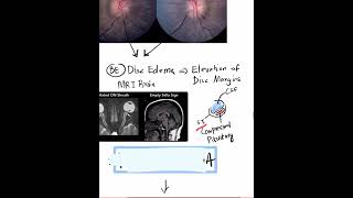 Papilledema  Case Discussion In A Minute Shorts [upl. by Akimat]