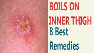 8 Best Remedies To Get Rid Of Boils On Inner Thigh [upl. by Anitnahs160]