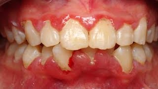 10 Tips To Reduce Swollen Gums At Home [upl. by Illona]