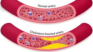 Understanding the difference of atherosclerosis plague and thrombus and their natural remedies [upl. by Ciprian833]