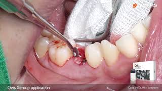 DENTIS Implant Lower premolar immediate implant placement amp immediate loading [upl. by Iret374]