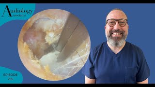 A quotPEELYquot GOOD EAR WAX REMOVAL  EP795 [upl. by Ralat]