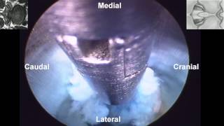 Percutaneous Endoscopic Interlaminar Lumbar Discectomy PEILD by Dr Hyeun Sung Kim01 [upl. by Ahcurb]