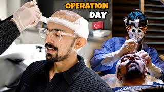 MY HAIR TRANSPLANT IN ISTANBUL TURKEY  Smile Hair Clinic  Part 2 [upl. by Yonit]