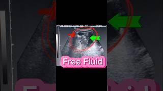 Ascites  Free Fluid  Bowel Loops  Abdominopelvis on Ultrasound [upl. by Wilhelmine]