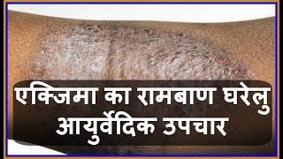 Health Tips एक्जिमा का रामबाण घरेलु आयुर्वेदिक उपचार  Charm Rog  Eczema ka Gharelu Upchar [upl. by Alyahsat]