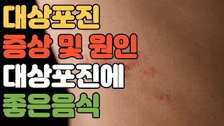 건강대상포진 증상 및 원인대상포진에 좋은 음식심한 통증 단순포진 마늘 버섯 견과류 등푸른생선 홍삼 양파 녹황색채소 생강 보리 [upl. by Hras127]