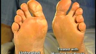 Miracle Foot Repair WMV 480p 4x3 [upl. by Vernon]