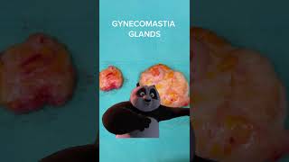 GYNECOMASTIA GLANDS [upl. by Colt181]