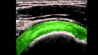 Musculoskeletal Ultrasound Shoulder 5 impingement test [upl. by Kore]