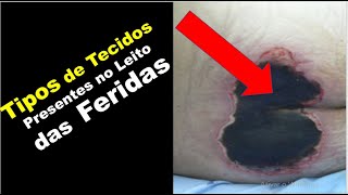 CURATIVOS Tipos de Tecidos Presentes no Leito das Feridas [upl. by Ttezzil]