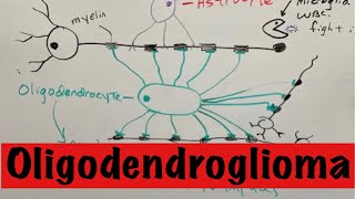 Oligodendroglioma [upl. by Ariaet]