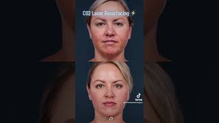 Revitalize Your Skin with CO2 Laser Resurfacing  The Ultimate Solution for Wrinkles and Scars [upl. by Vaden]