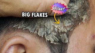 Big and Dry Dandruff Flakes Removal Dandruff Scratching Satisfying 356 [upl. by Cleopatra22]