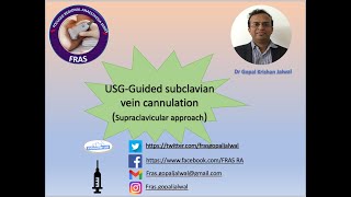 USG guided Subclavian vein cannulation Supraclavicular approach [upl. by Wilde]