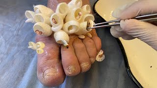 Parasites almost ate this foot  Saved a limb from trypophobia [upl. by Salakcin366]