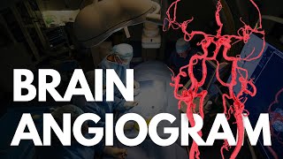 Angiogram  BRAIN angio procedure video [upl. by Htebsle389]