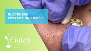 Blackhead amp Whitehead Extractions on K [upl. by Marba802]