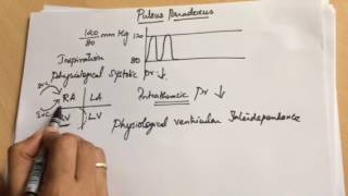 Pulsus paradoxustamponade [upl. by Merrel]