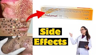 Melamet Cream Ke kya Side Effects Hote Hai । Solution  melamet cream kaise use kare  Onlyone [upl. by Adnael429]