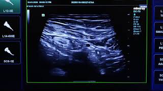 Epiploic Appandagitis Ultrasound [upl. by Eohce]