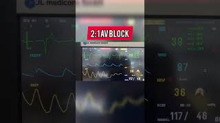 Second degree AV block ecg cardiology heart heartphysiology [upl. by Adalard]