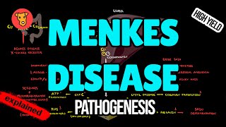 MENKES DISEASE Pathogenesis Clinical symptoms Treatment for USMLE [upl. by Naivatco]