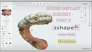 Live Fully Guided Implant Surgery using Dentium Fully Guided kit amp 3Shape Implant Studio Part 2 [upl. by Melisa]