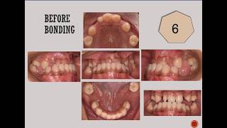 Different Types of Malocclusion  Treatment at BPKIHS Dharan Department of Orthodontics [upl. by Greenes]