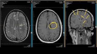 ADC Positive Multiple Sclerosis  Demyelination MRI Case Review [upl. by Colver506]