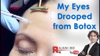 My Eyes Drooped after BotoxDr Rajani [upl. by Attenauqa]