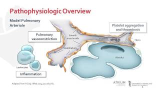 Pathophysiology of Pulmonary Arterial Hypertension [upl. by Peonir560]