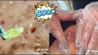 Ultimate Satisfying Acne Removal Compilation Best Pimple Pops Blackheads and Cysts [upl. by Hengel227]