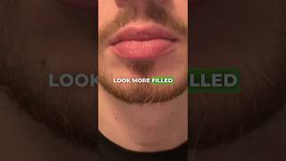 How To Remove Fordyce Spots in 20 Seconds🤩⏱️ [upl. by Robet819]