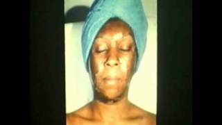 Skin Culture Chemical Skin Peel Lecture  Part 2 [upl. by Othella]