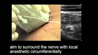 Popliteal Sciatic Nerve Block  Out of Plane Approach [upl. by Ezaria668]