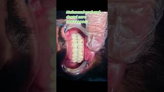 Patient with severe decayed teeth treated successfully [upl. by Charley983]