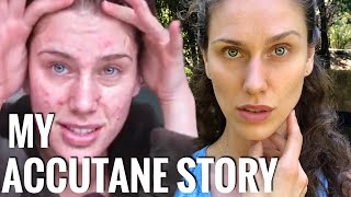 My Accutane Story My Acne Meds  Why I Never Took IsotretinoinAccutane [upl. by End357]