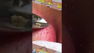 Blackhead Removal Acne Removal Treatment 030 [upl. by Nnayllehs11]