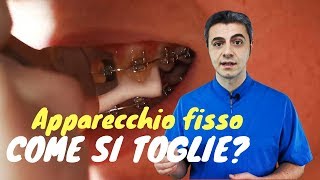 Come si toglie lapparecchio fisso [upl. by Maharg]